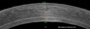 greffe de cornée cornea graft oct optovue