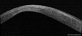 oct keratoconus keratocone cornee optovue