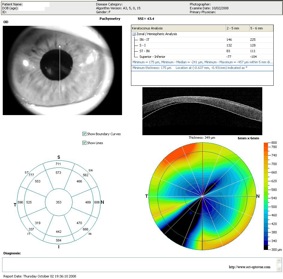 oct keratoconus keratocone cornee optovue