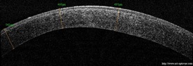 oct keratoconus keratocone cornee optovue