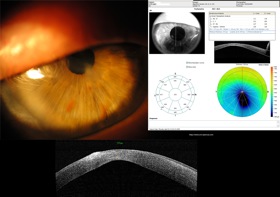 oct keratocone keratoconus thin cornea