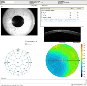 oct keratoconus keratocone cornee optovue