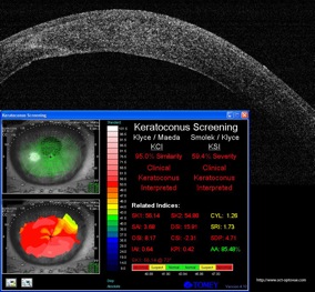 oct keratoconus keratocone topographie corneal topography