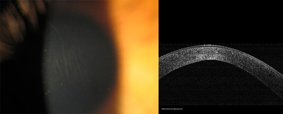 oct keratoconus keratocone stries vogt