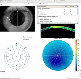 oct keratoconus keratocone cornee optovue