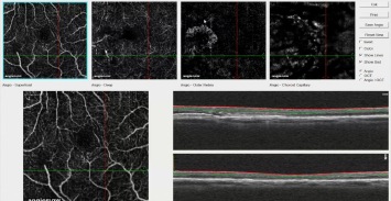 CNV & AMD (OCT Angiography)