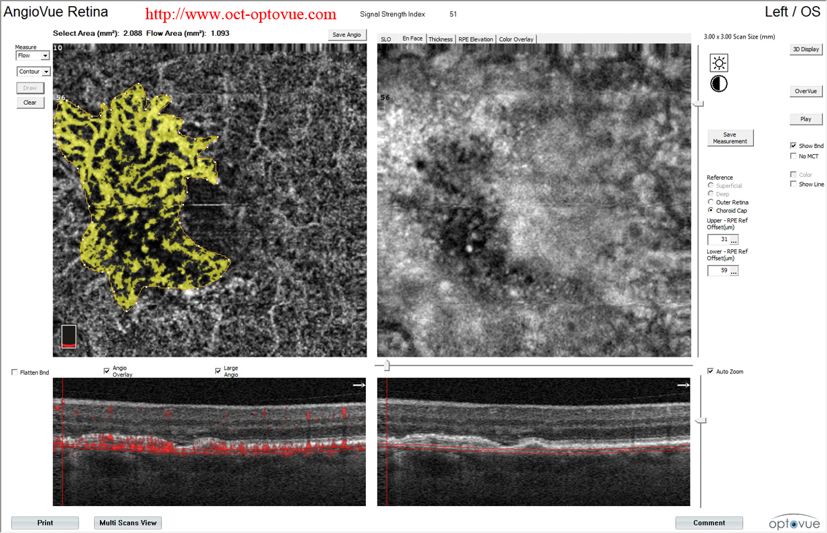 angioAnalytics oct-angiography density nonflow noflow  flow