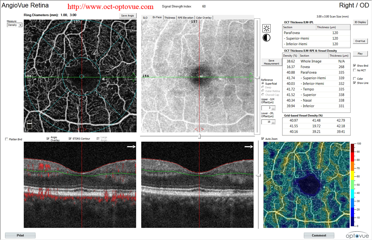 angioAnalytics oct-angiography density nonflow noflow  flow