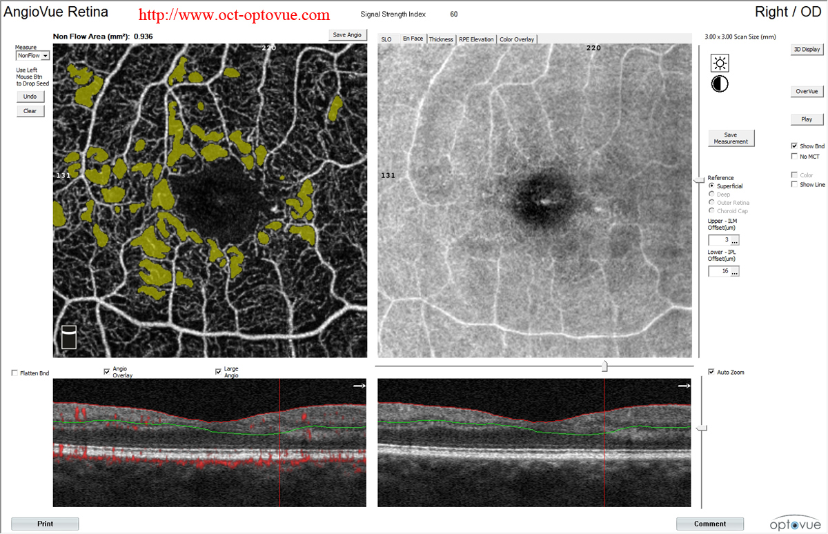 angioAnalytics oct-angiography density nonflow noflow  flow