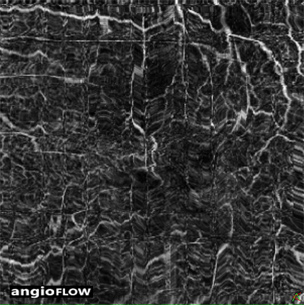 artifact oct-angiography eye motion