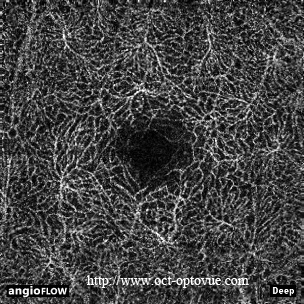 deep retina angio oct muratet pamiers ophtalmologiste