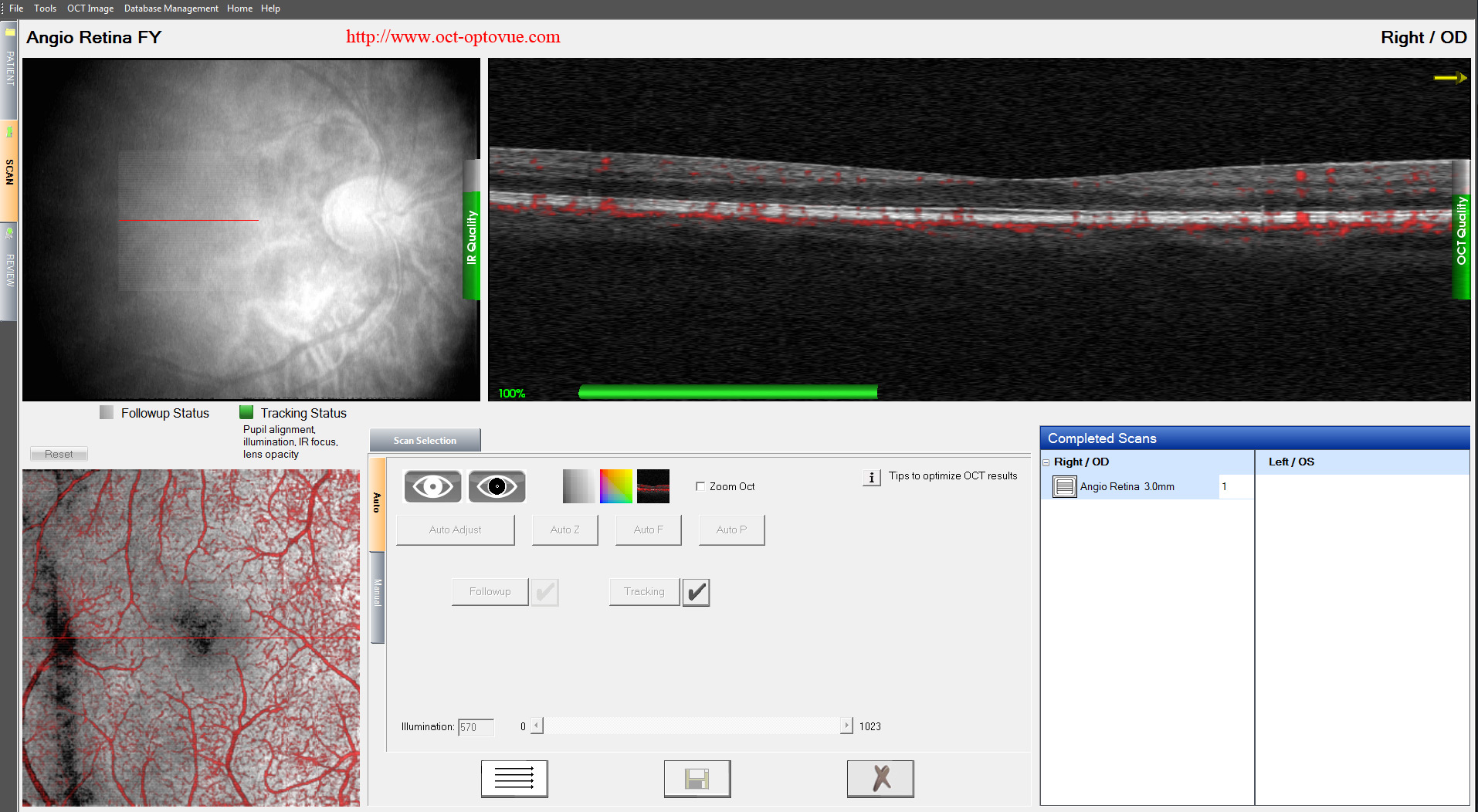 dualtrac-eyetracking optovue  octa