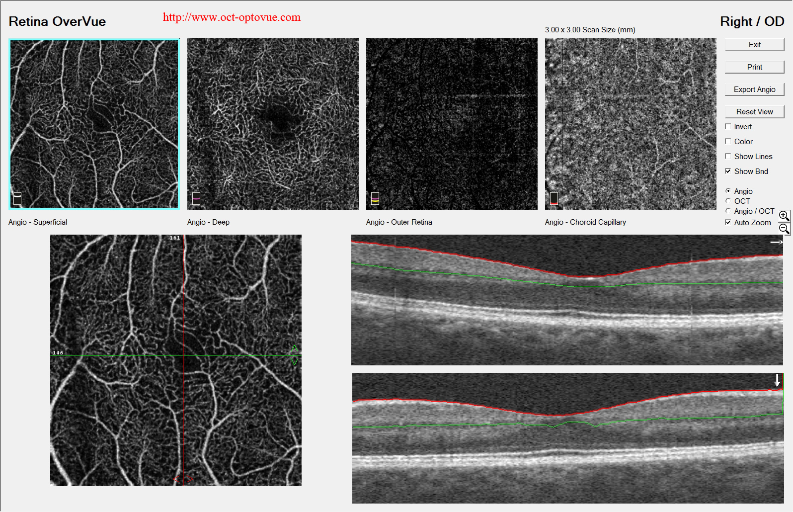 dualtrac-eyetracking optovue  octa motion correction