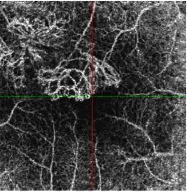 néovaisseaux occultes oct angiography