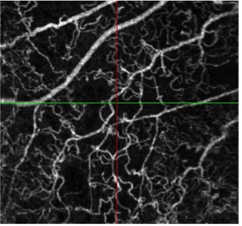 obcvr angiography oct retina macula