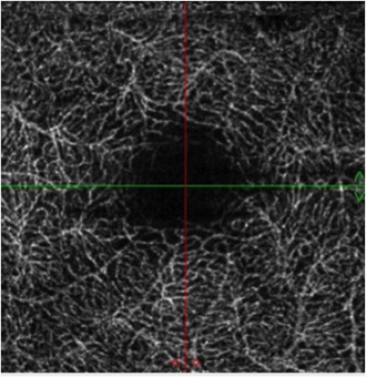 plexus vasculaire profond