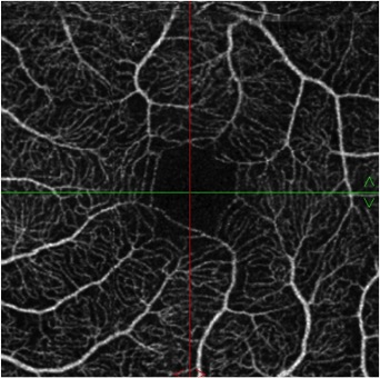 plexus vasculaire superficiel