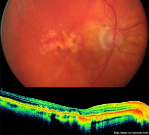 atrophie rétinienne retinal atrophy armd