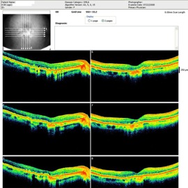 atrophie maculaire oct retina atrophy