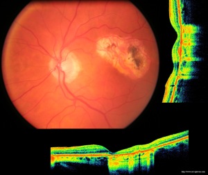 atrophie rétinienne retinal atrophy armd