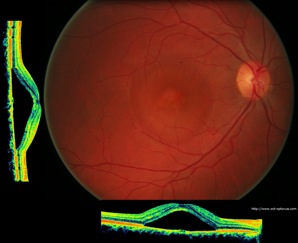 crsc retina oct crcs serous séreuse centrale