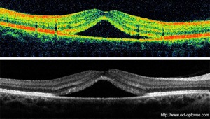 crsc oct crcs retina baisse de vision