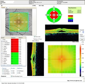 crsc oct crcs serous séreuse centrale retina