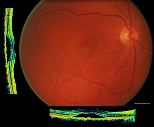 crsc retina oct crcs serous séreuse centrale