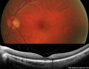 oct diabète rétinopathie diabétique diabetic retinopathy oct