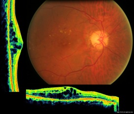 diabete diabetic retinopathy retinopathie oct