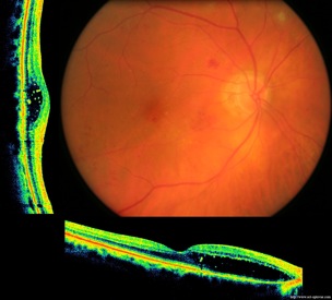 diabete diabetic retinopathy retinopathie oct