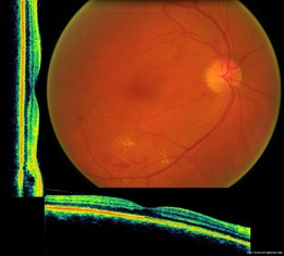 oct diabète rétinopathie diabétique diabetic retinopathy oct