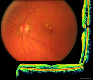 diabete diabetic retinopathy retinopathie oct