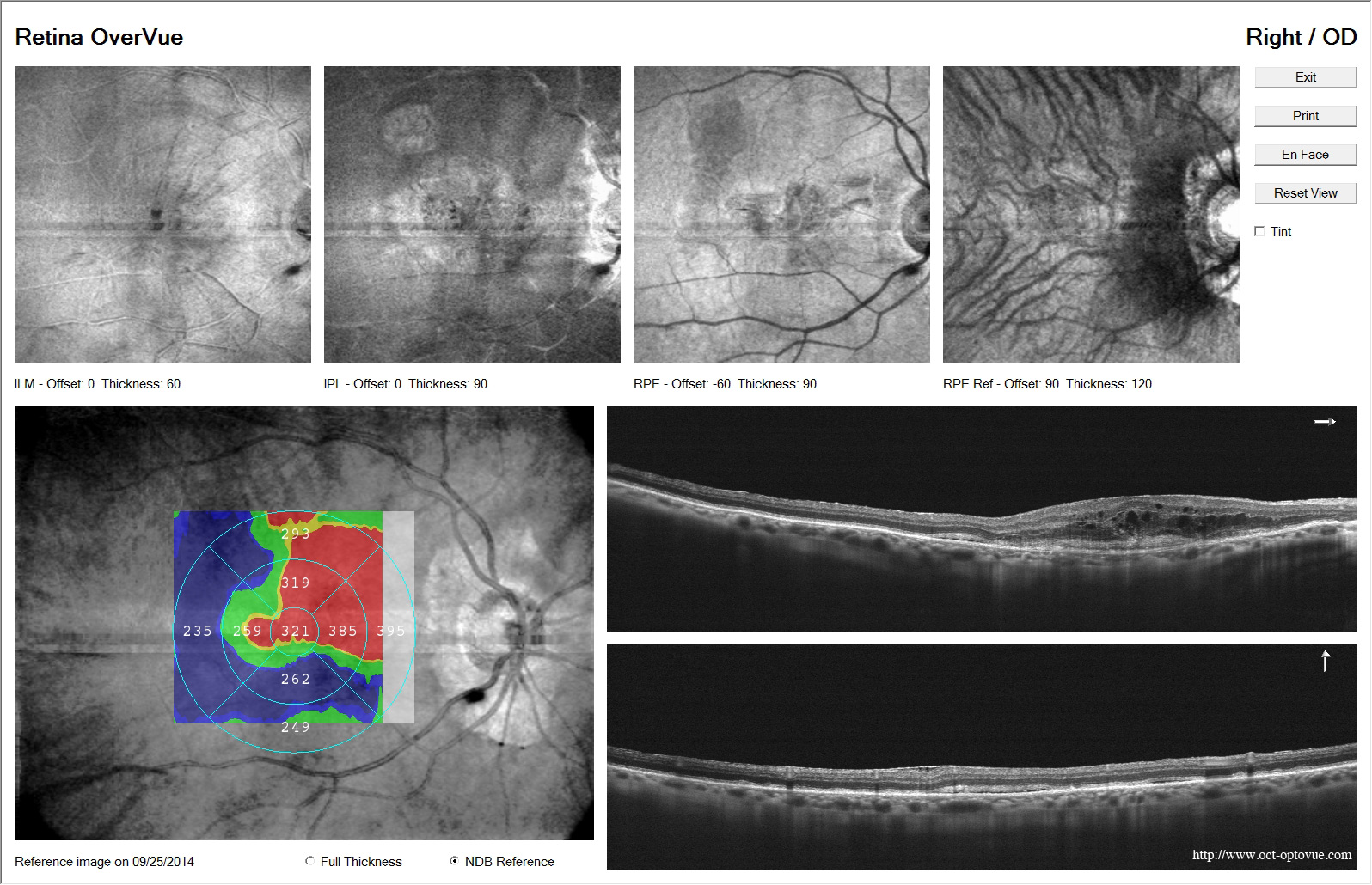 ARMD DMLA avanti neovascularisation