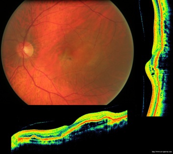 cicatrice lucentis dmla armd ivt retina retine