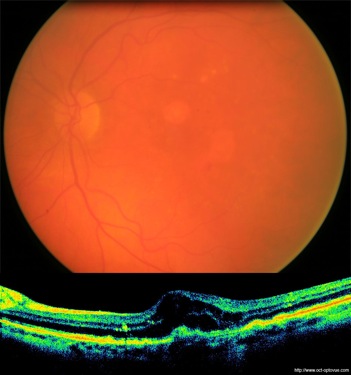 lucentis dmla armd ivt retina retine