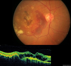 oct armd dmla retine dégénérescence maculaire