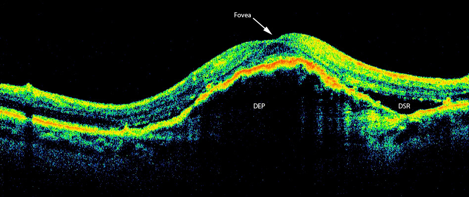 oct exudative armd dsr dep néovaisseaux occultes occult cnv