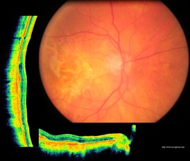 dmla armd retine fibrosis fibrose