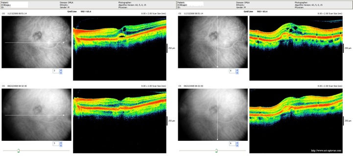 recidive lucentis dmla armd ivt retina retine