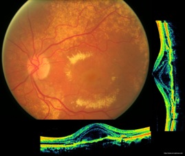 oct wet armd dmla humide néovaisseaux