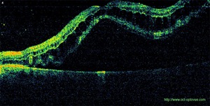 décollement rétine retina detachment oct optovue