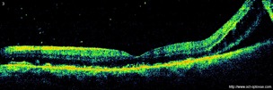 dr retinal detachment retine décollement rétine oct