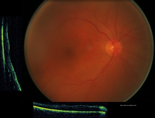 décollement rétine retina detachment oct optovue