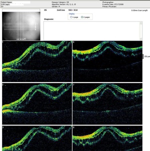 décollement rétine retina detachment oct optovue