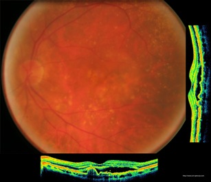 drusen armd exsudative nvo nvv dep dsr