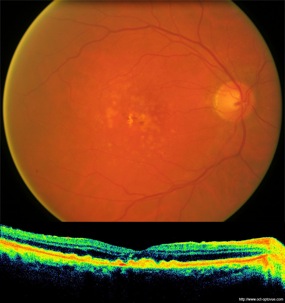 druses dmla macula retina drusen