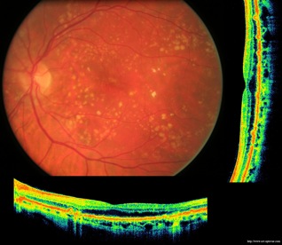 drusen retinopathy druses retinopathie