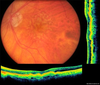 oct druses retina retine drusen dmla