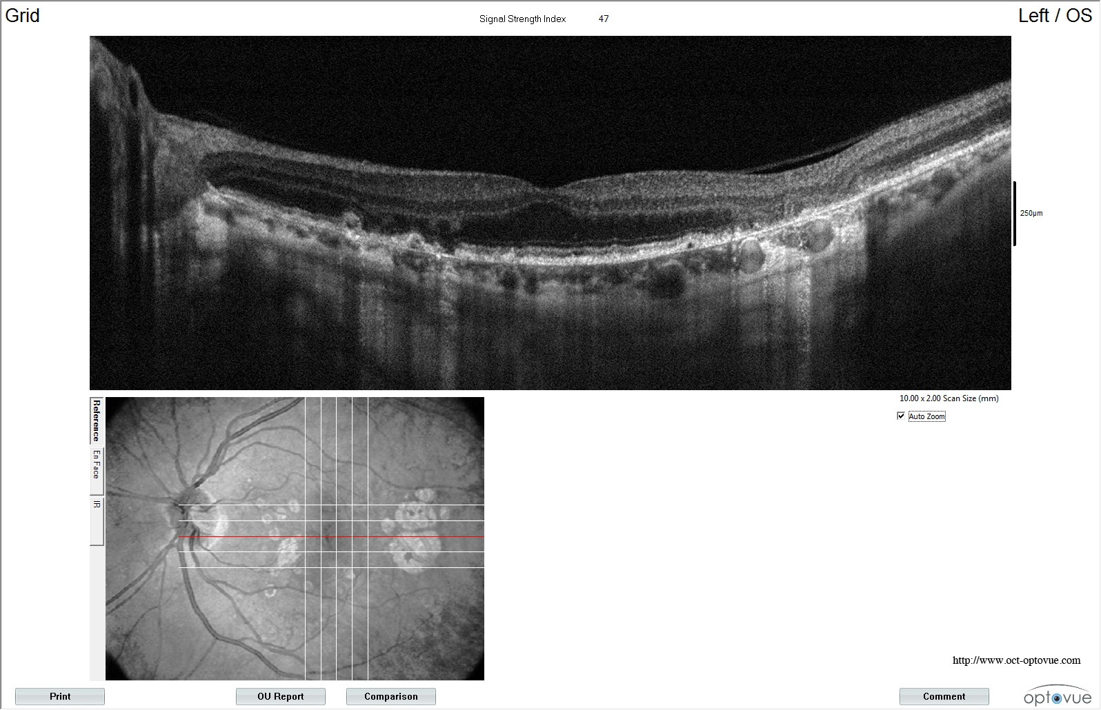 oct drusen druses avanti xr optovue